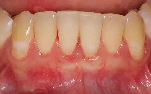 Connective Tissue Graft After Treatment