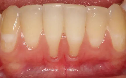 Connective Tissue Graft Before Treatment