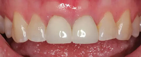 Connective Tissue Grafting After Treatment