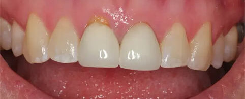 Connective Tissue Grafting Before Treatment