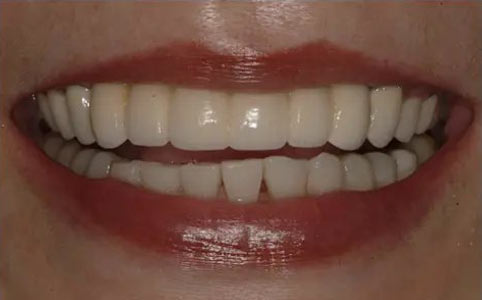 Crown Lengthening & Implants 2 After Treatment