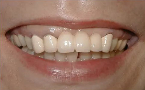 Crown Lengthening & Implants 2 Before Treatment