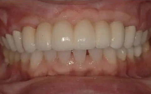 Crown Lengthening & Implants After Treatment