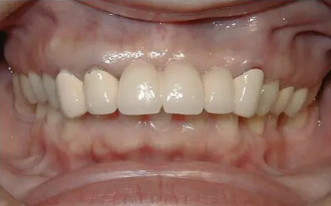 Crown Lengthening & Implants Before Treatment