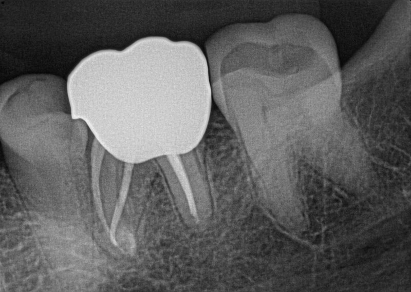Endodontic Case 2 After Treatment