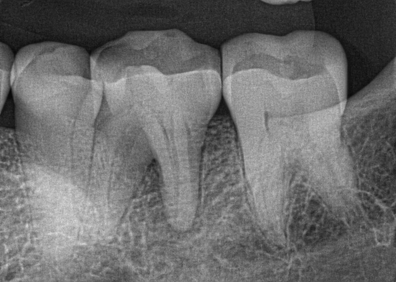 Endodontic Case 2 Before Treatment
