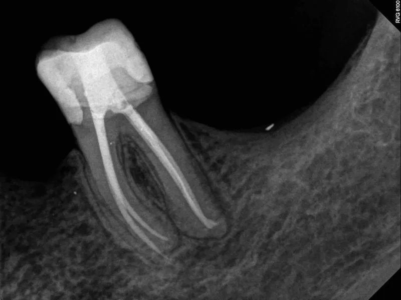 Endodontic Case 3 After Treatment