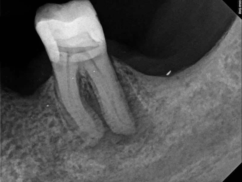 Endodontic Case 3 Before Treatment