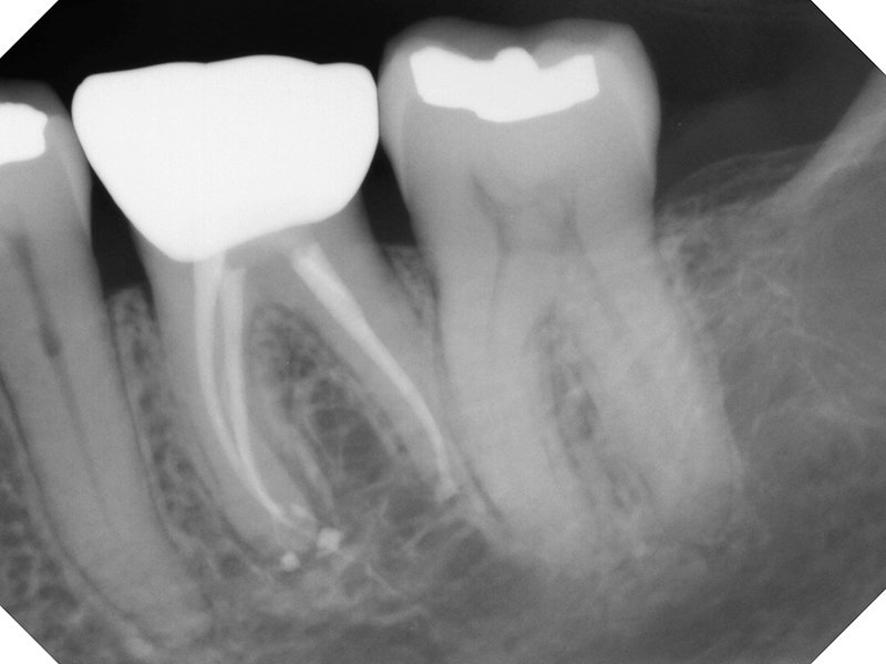 Endodontic Case 4 After Treatment