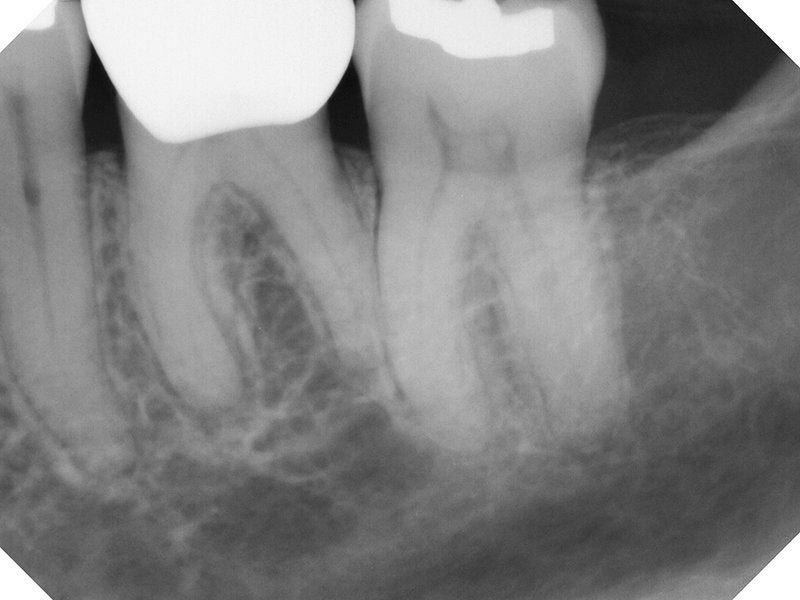 Endodontic Case 4 Before Treatment