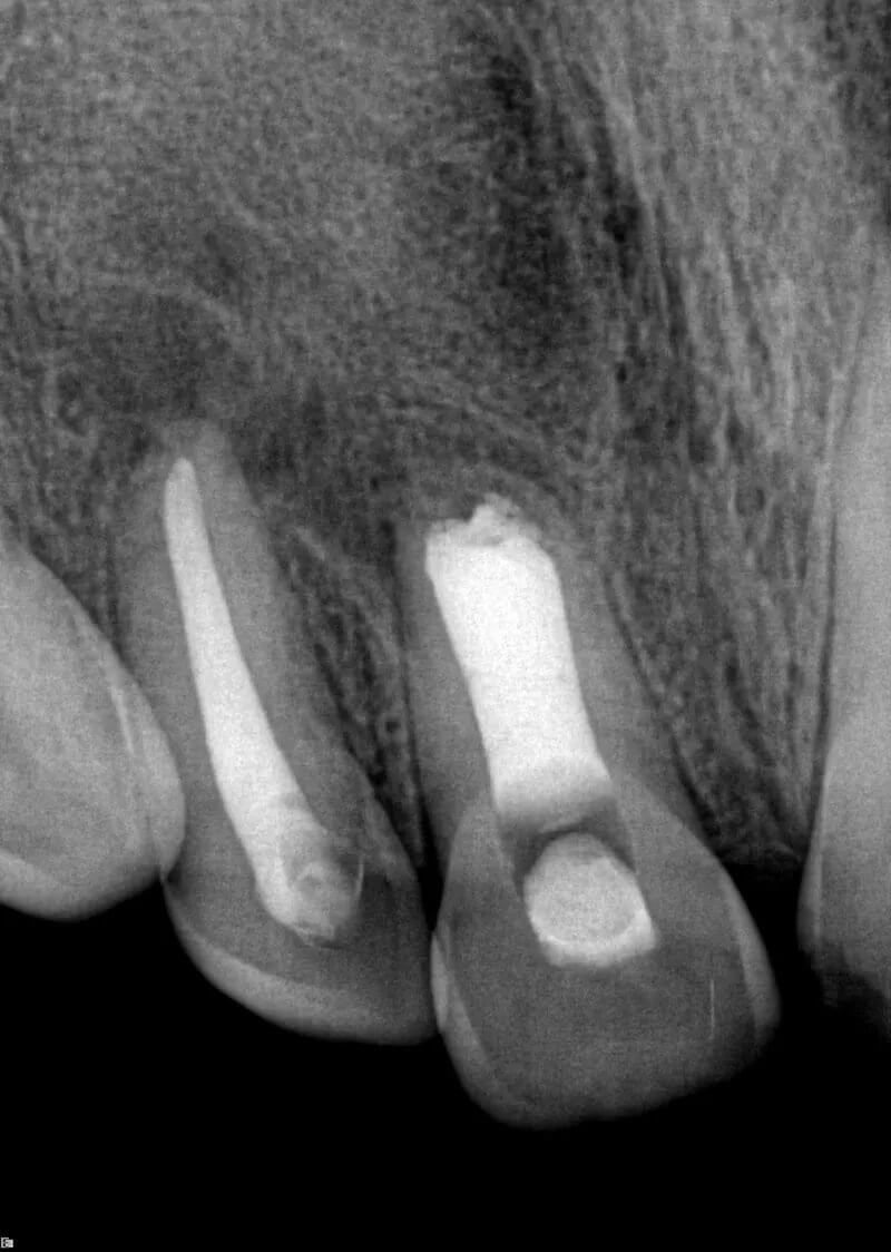 Endodontic Case After Treatment