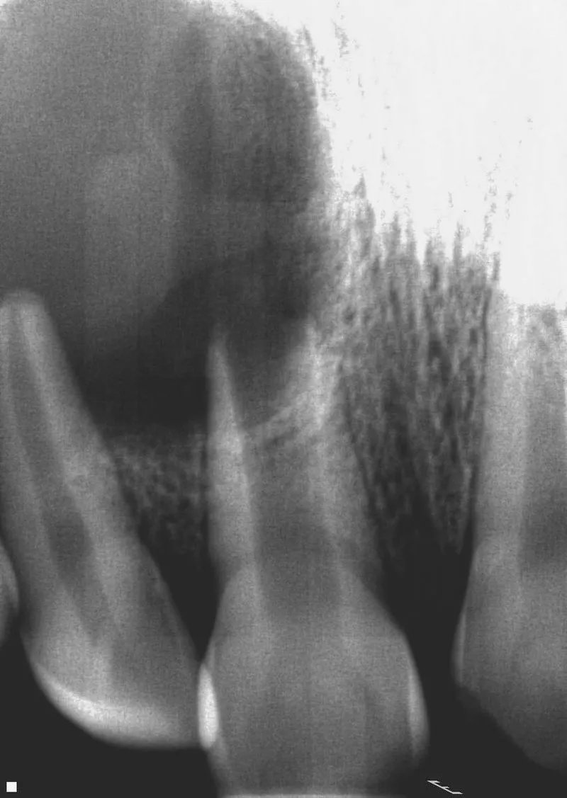 Endodontic Case Before Treatment