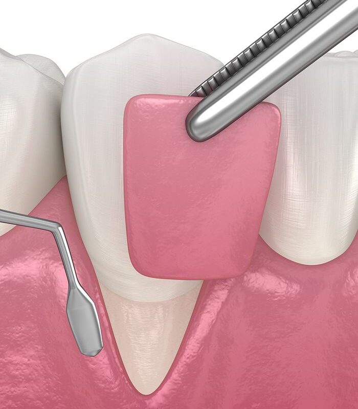 Soft tissue graft surgery. 3D illustration