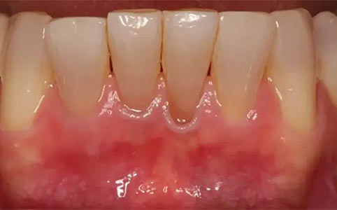 Free Gingival Graft Before Treatment