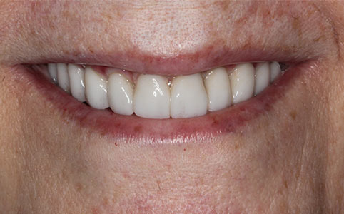 Full Arch Implants Case 2 After Treatment