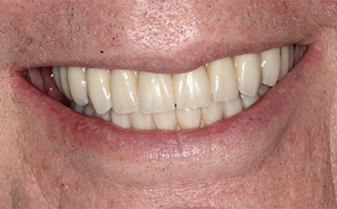 Full Arch Implants Case After Treatment