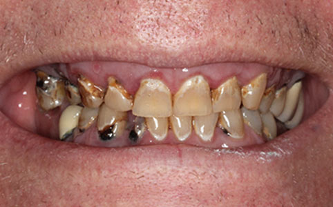 Full Arch Implants Case Before Treatment