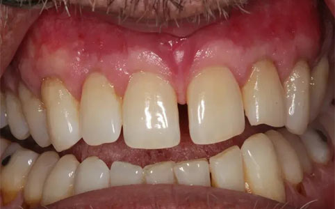 Full Arch Soft Tissue Grafting Using Donor Tissue After Treatment
