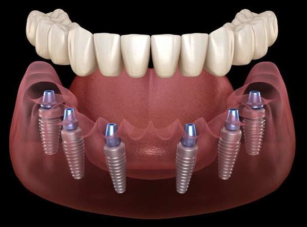 All on 4 system supported by implants