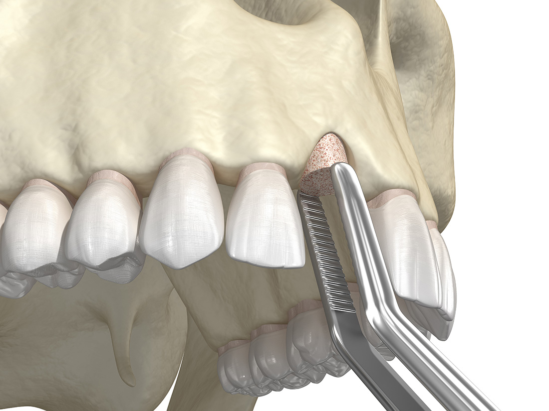 Bone grafting using ring method
