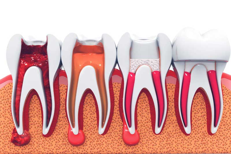 stages of root canal treatment.3d render