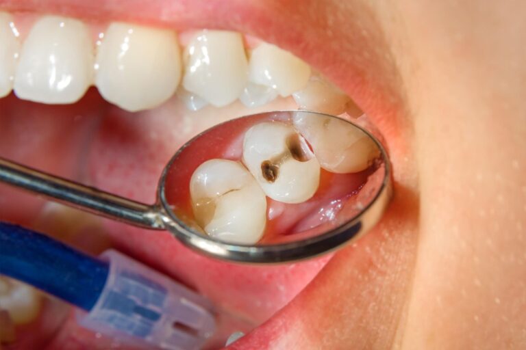 Filling with dental composite photopolymer material using rabbders