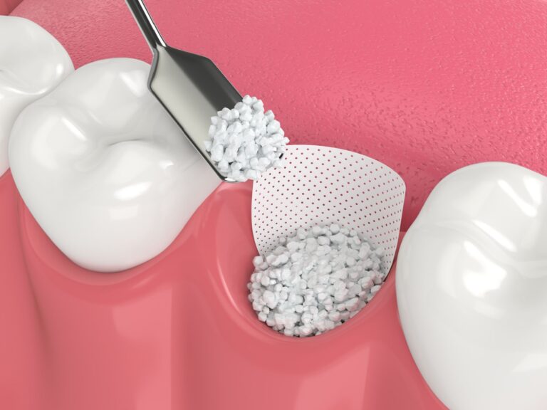 3D render of dental bone grafting with bone biomaterial