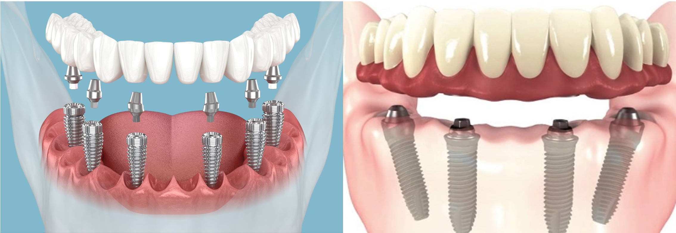 Implant-Supported Dentures