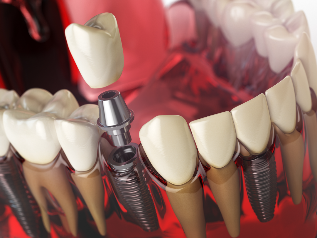 Dental Replacement