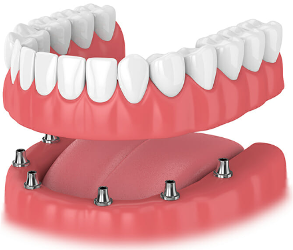 Dentures vs implants