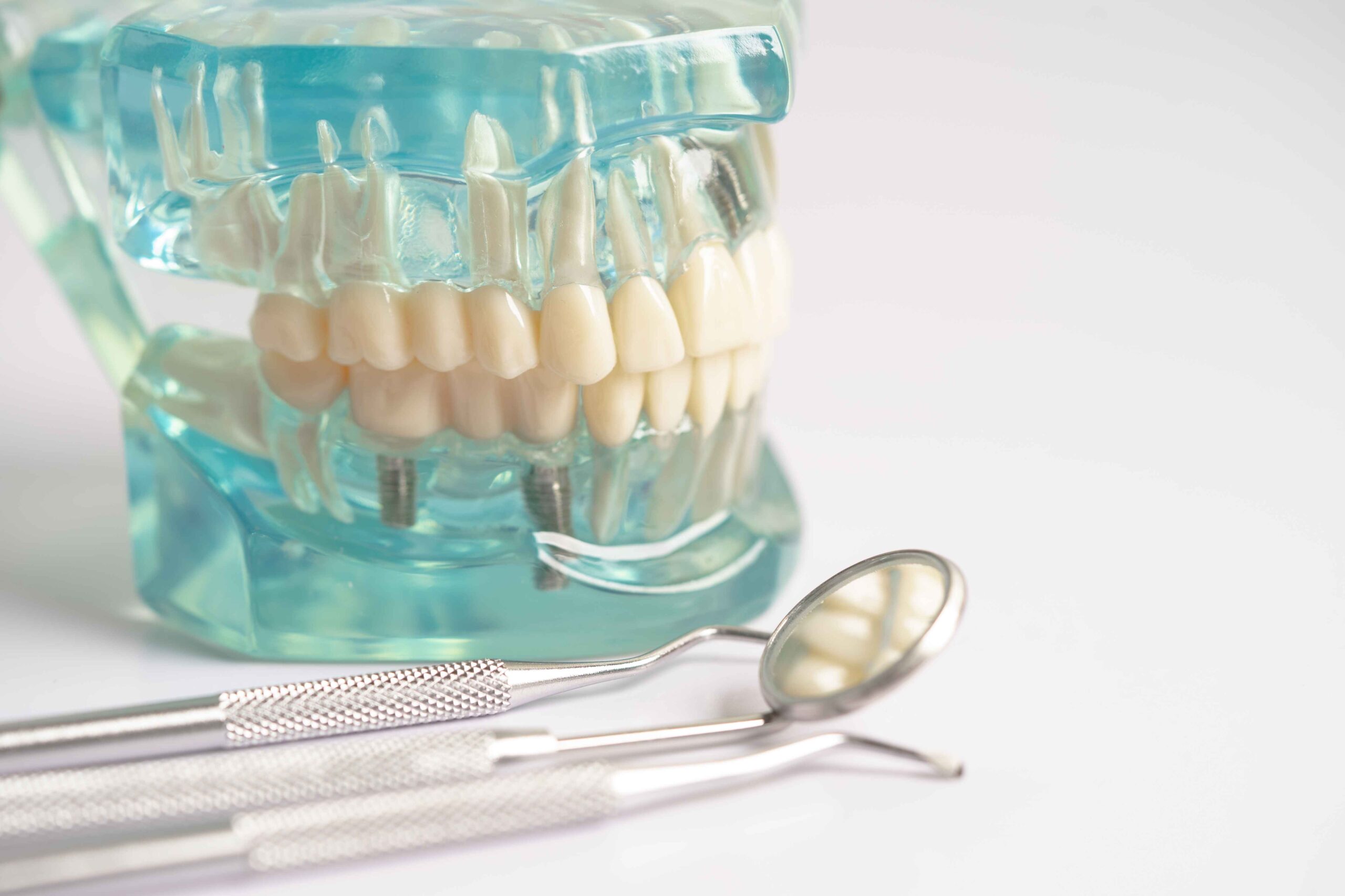 Full arch dental implants