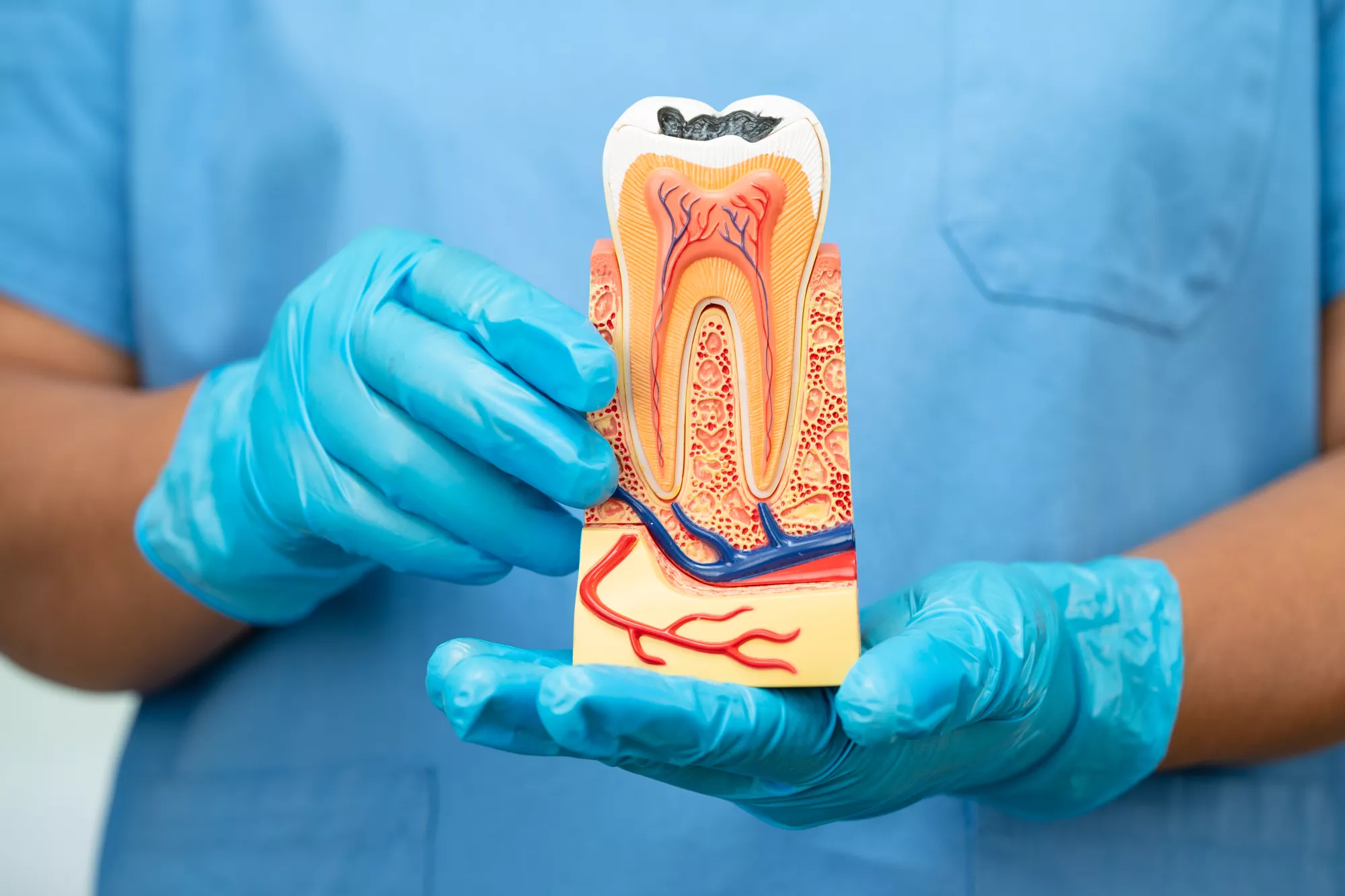 Root canal