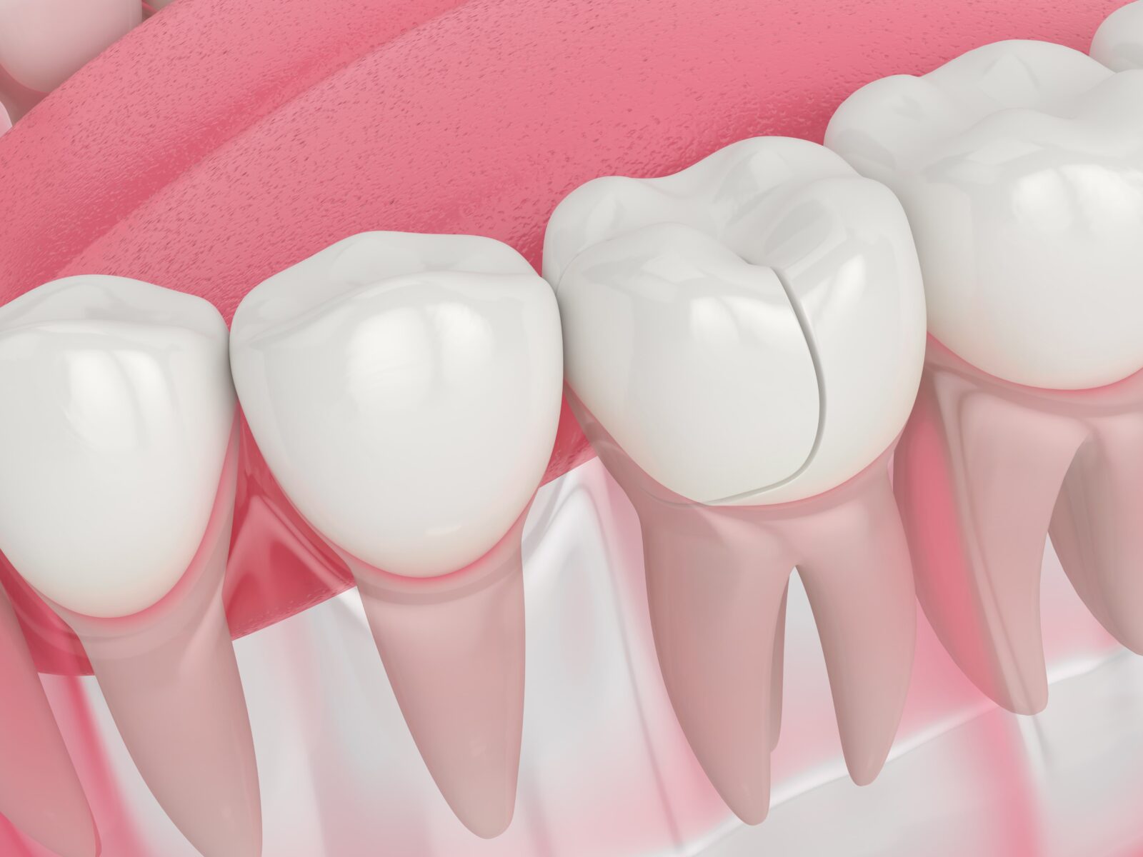 Illustration of a cracked tooth in need of emergency dental care