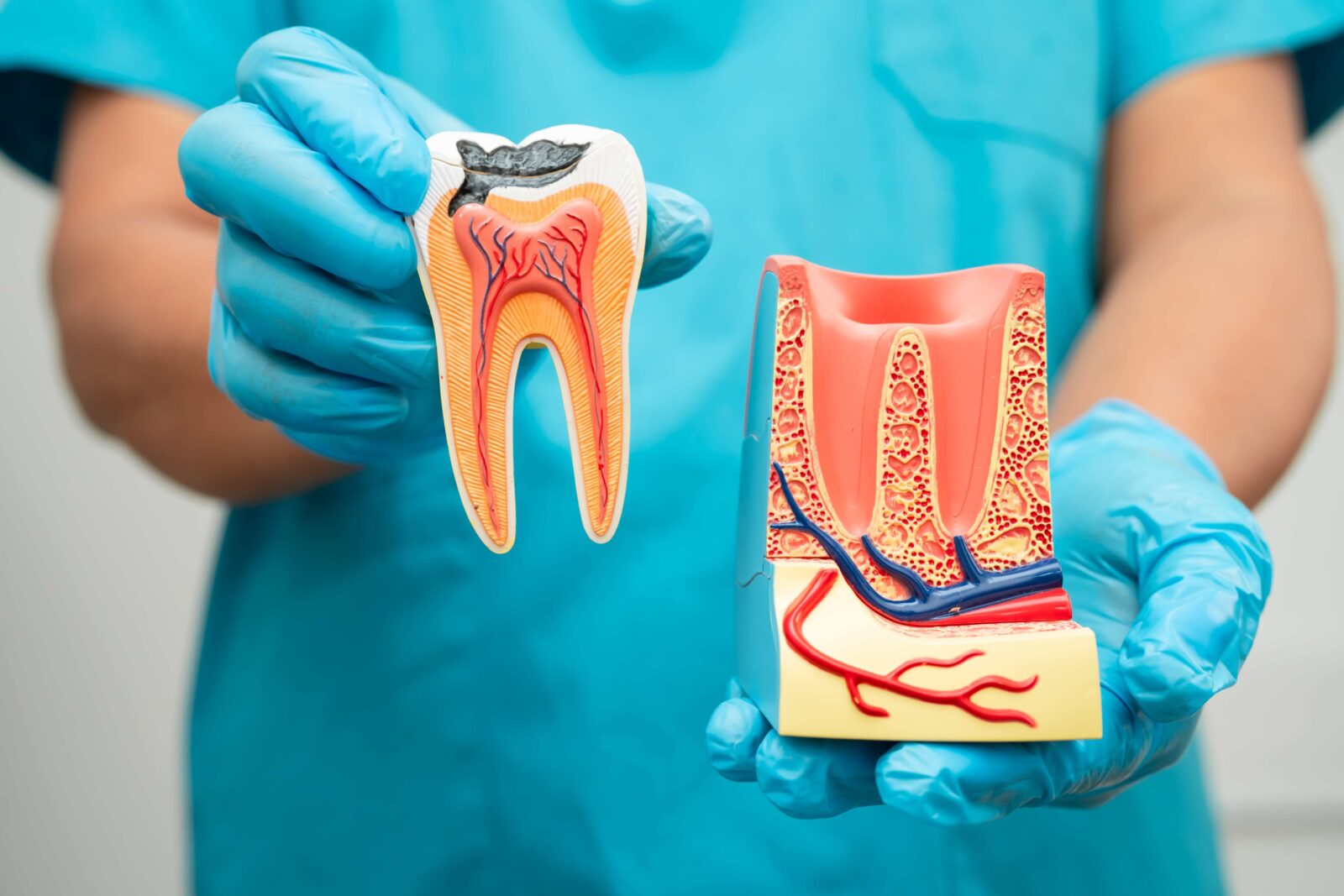 Dentist holding molds that show a root canal procedure