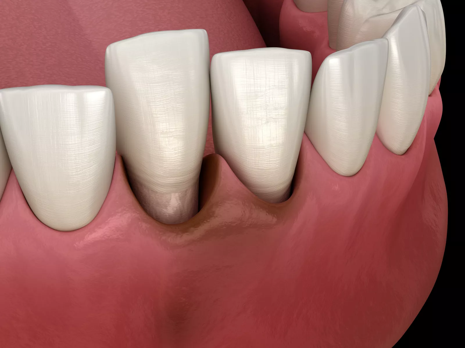 gum disease stages