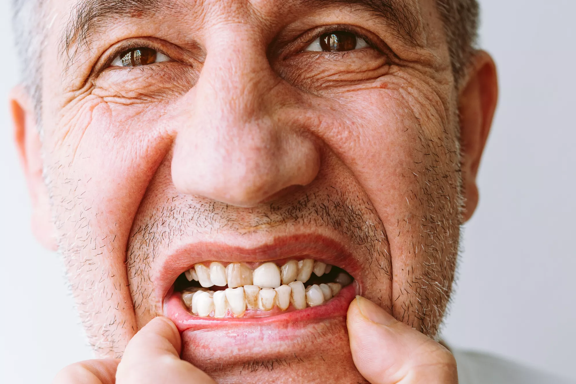Periodontal Disease