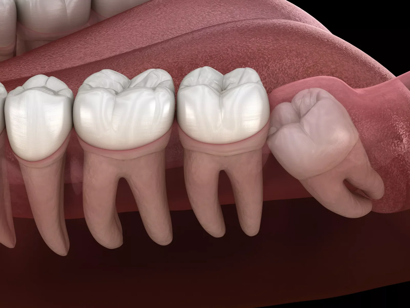 Wisdom Teeth