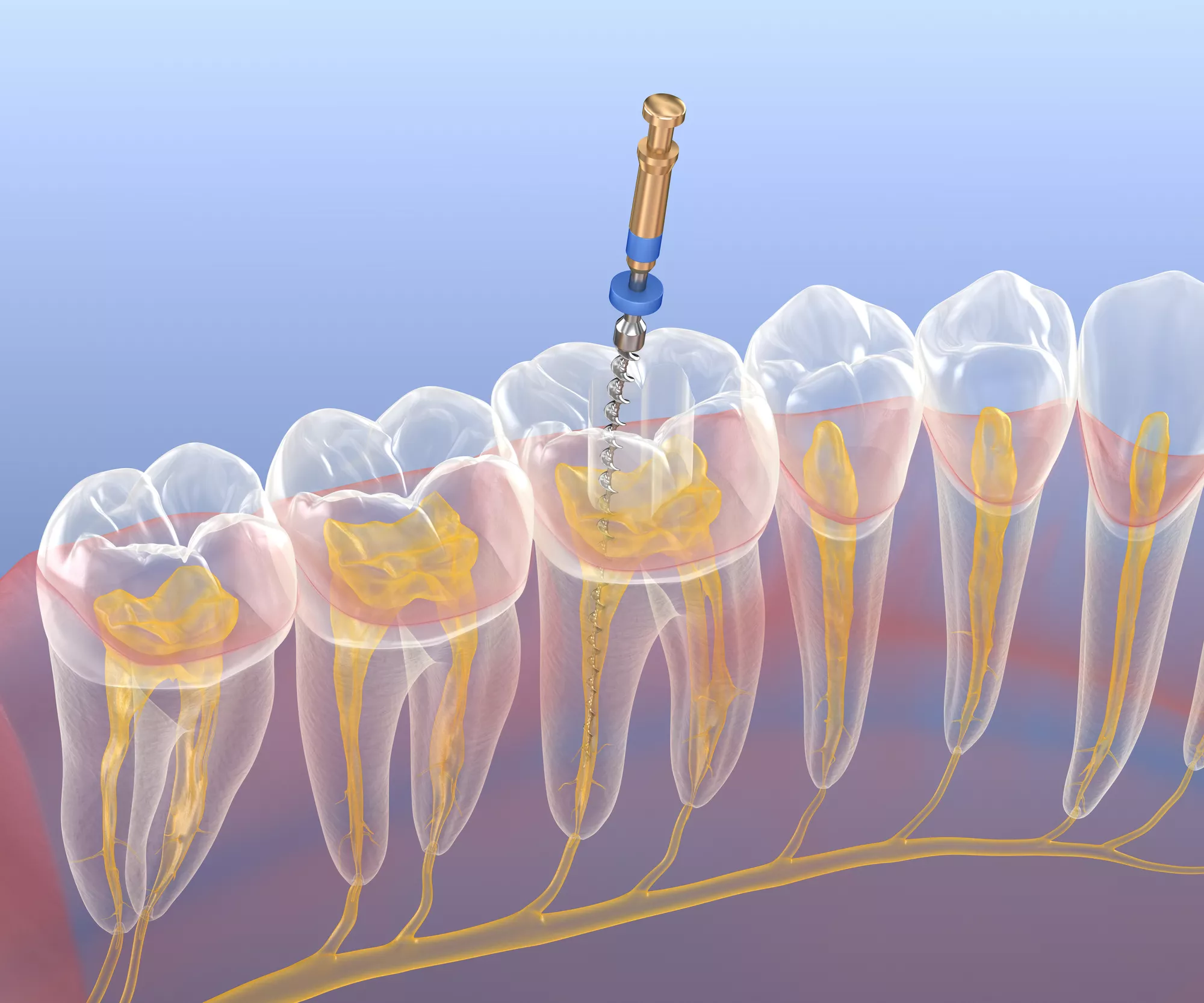 Apico Surgery