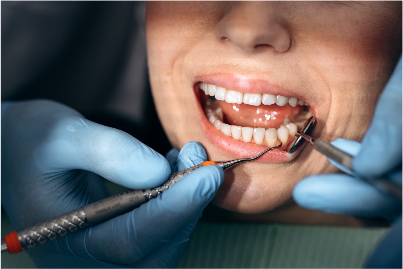 gingivitis vs periodontal disease