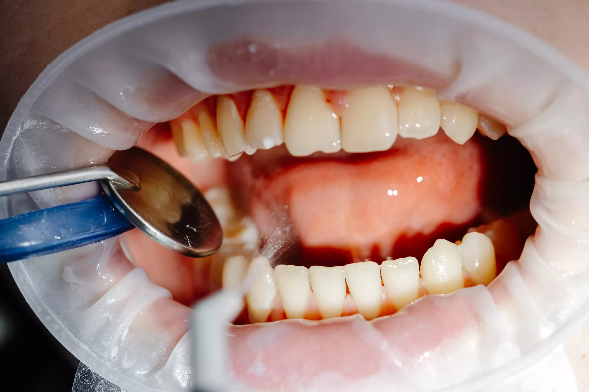 What is Gingivitis