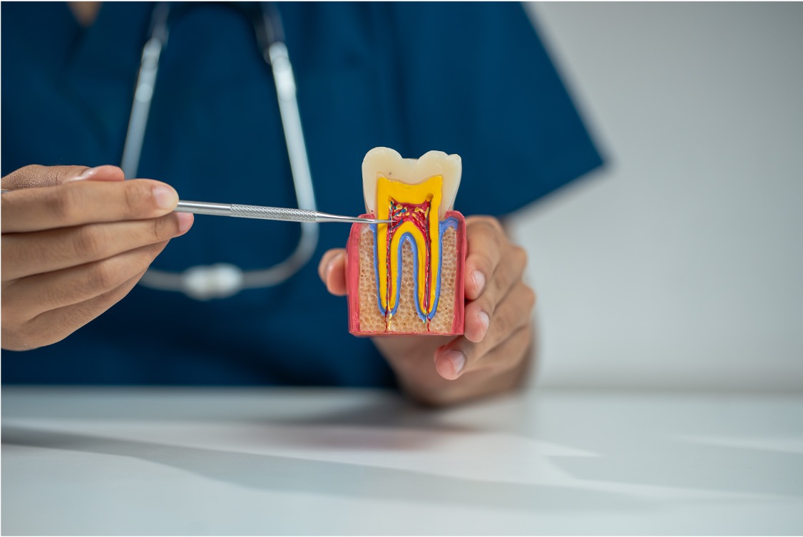 root canal treatment