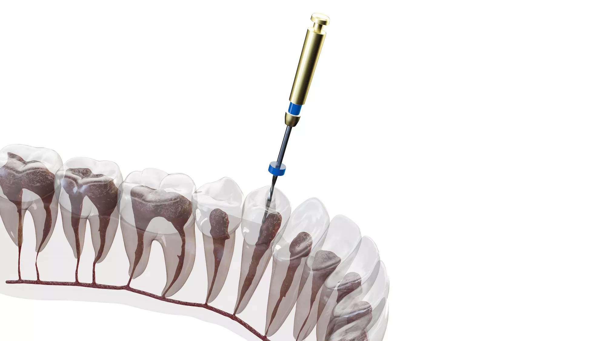 Endodontic Treatment