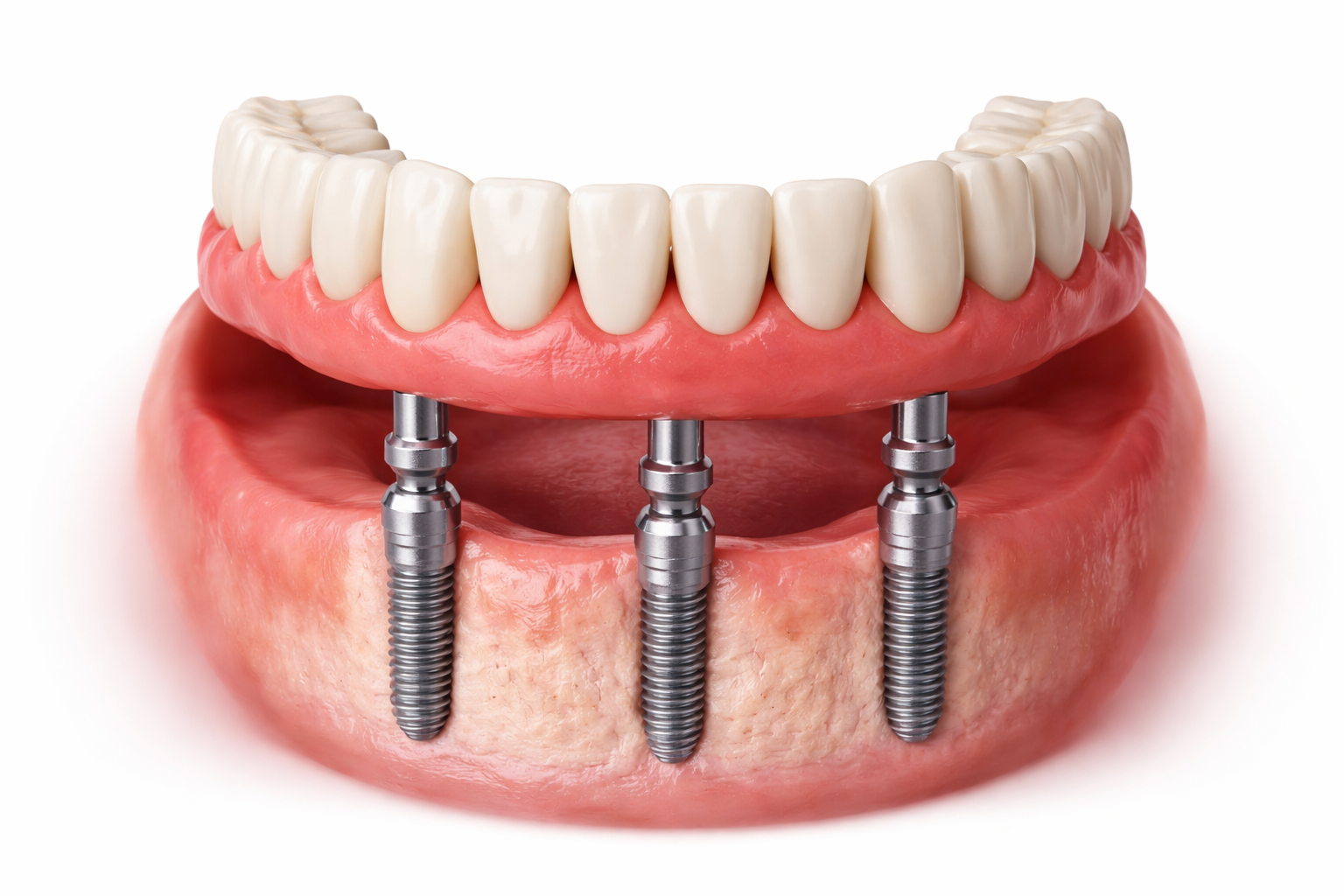 Fixed full arch dental implants