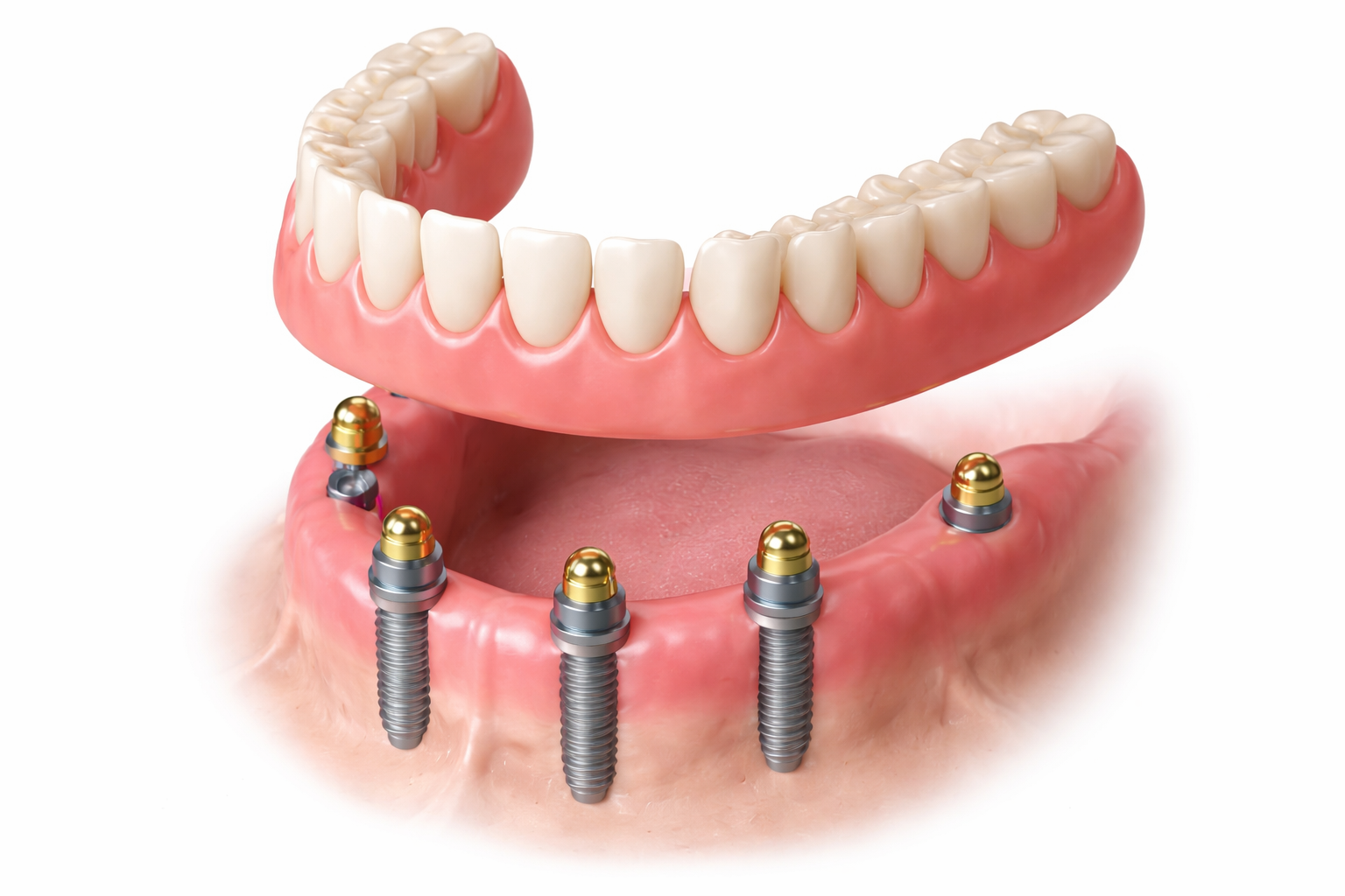 Example of implant overdentures