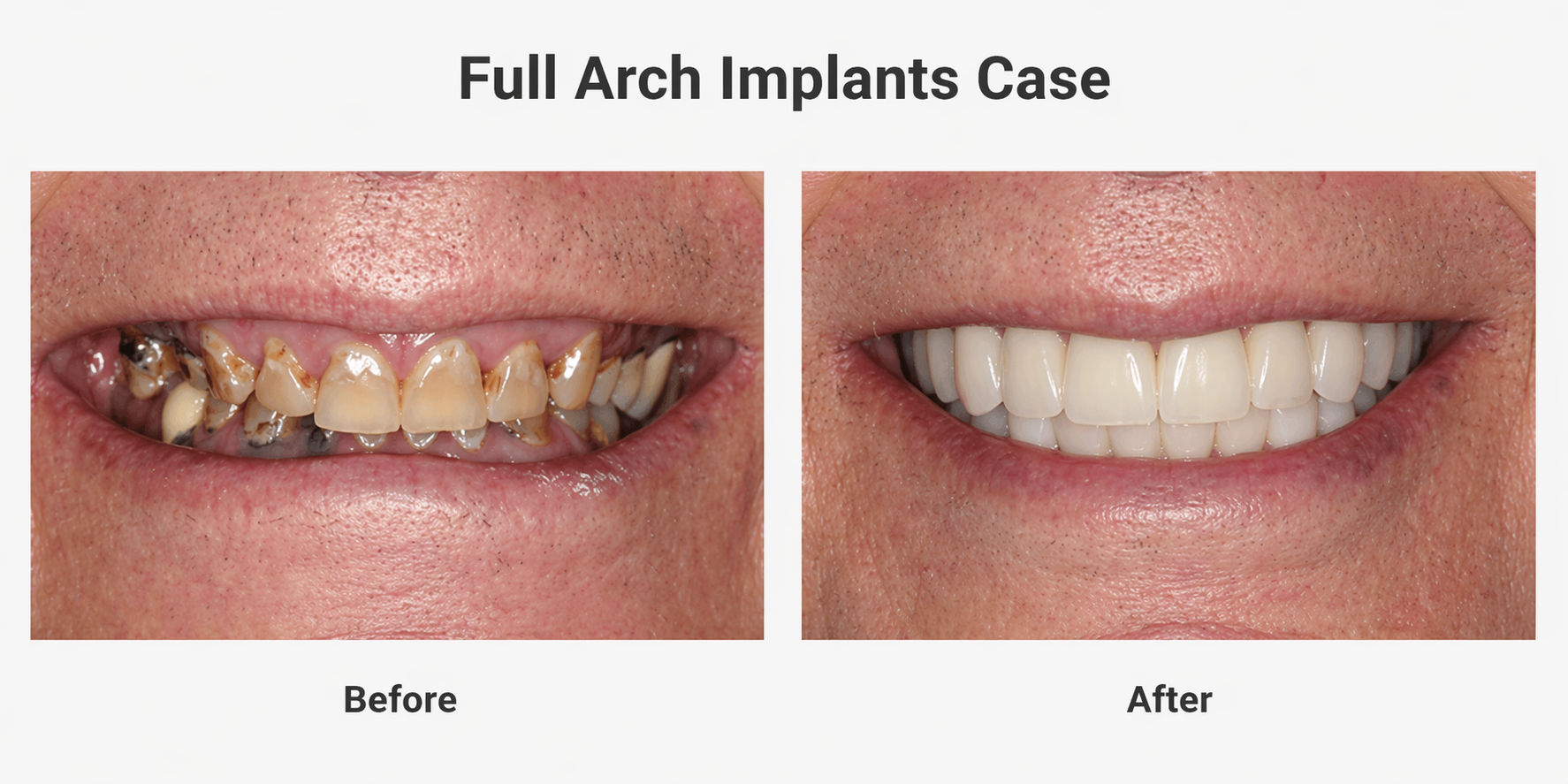 before and after full arch dental implants example