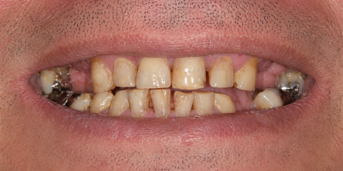 Example of a person's teeth before full arch dental implants