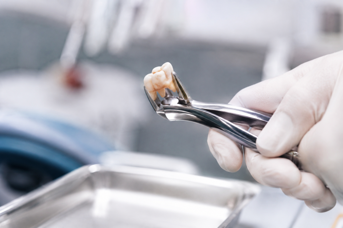 Tooth extraction