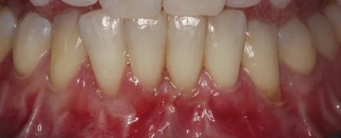 Full Arch Soft Tissue Grafting After Treatment
