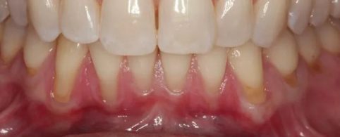 Full Arch Soft Tissue Grafting Before Treatment